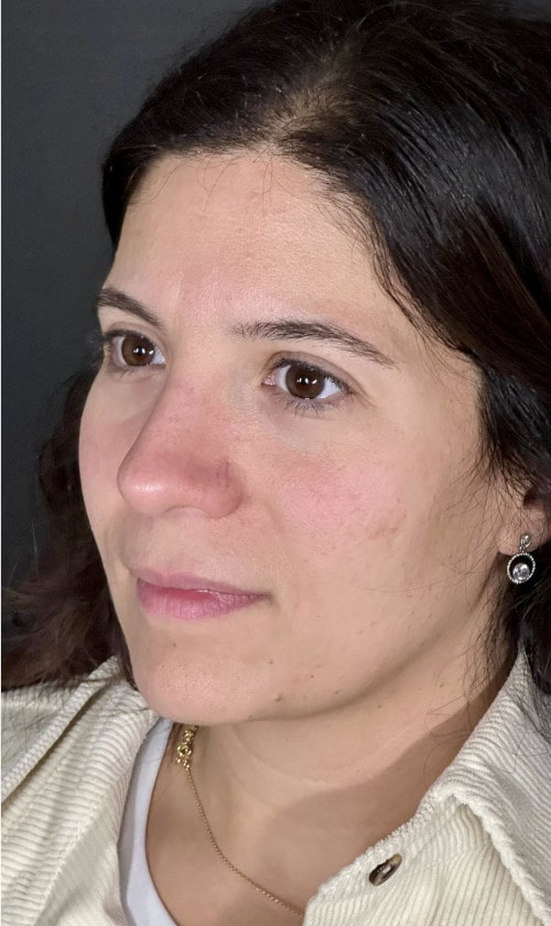 Rhinoplasty – after surgery side profile showing corrected tip and straighter nasal contour