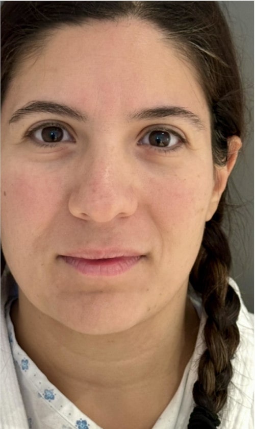 Rhinoplasty – before surgery showing patient’s nose from the front with dorsal bump