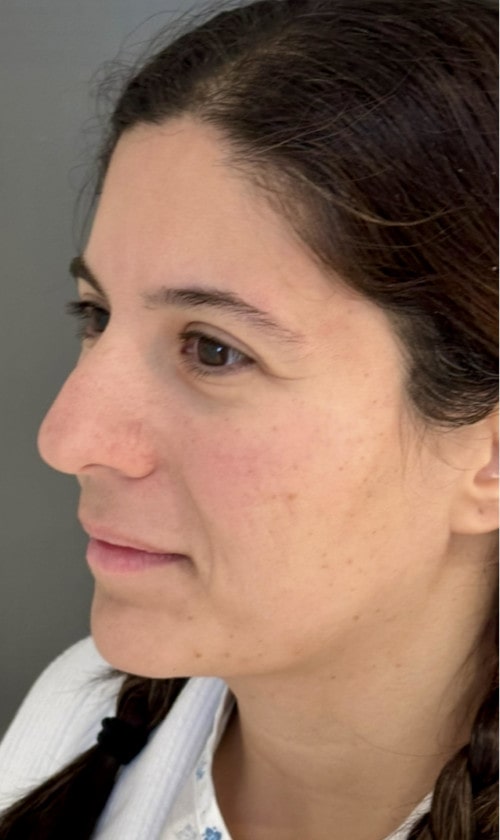 Rhinoplasty – before surgery showing side profile of the nose with droopy tip