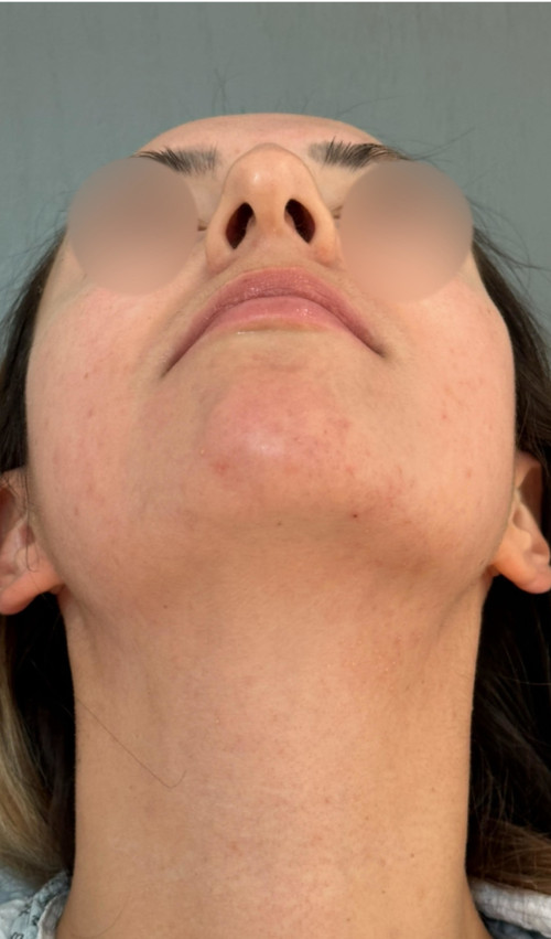 Rhinoplasty – 1 year after surgery showing refined, narrowed tip and proportionate nose