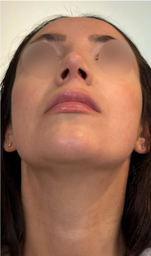 Rhinoplasty – one year post-op showing stable, refined nose with narrowed tip and harmonious shape