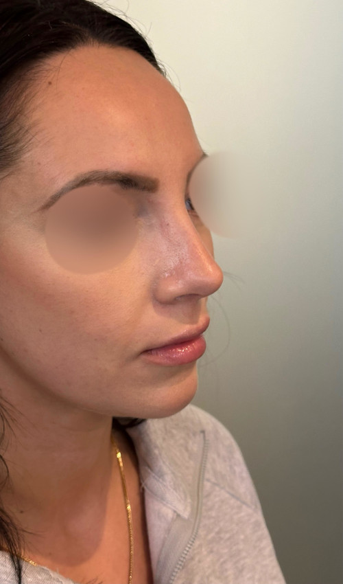 Rhinoplasty – after surgery side profile showing smoother dorsal bump and proportionate tip