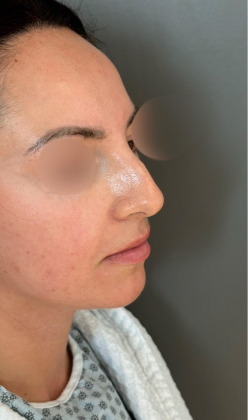 Rhinoplasty – before surgery showing side profile with dorsal bump and wide tip