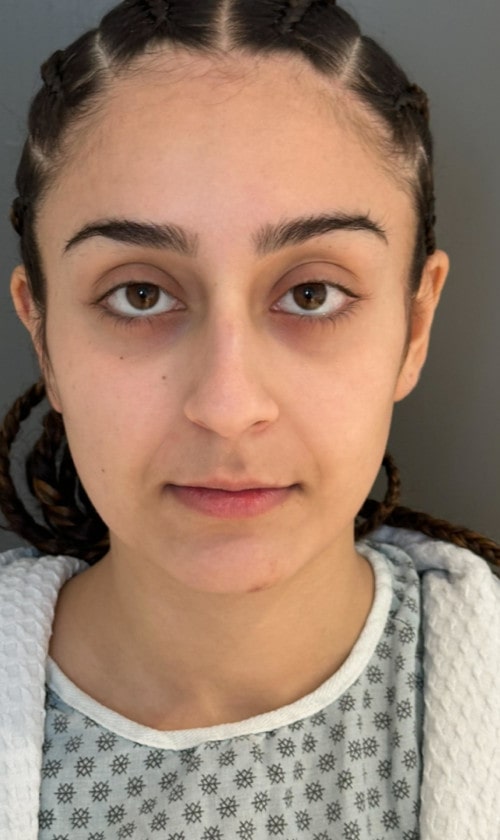 Rhinoplasty – 4 months after surgery showing smoother, balanced nose from the front