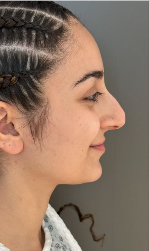 Rhinoplasty – 4 months after surgery showing improved side profile and refined tip