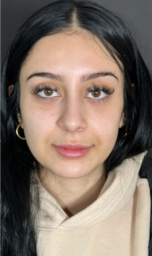 Rhinoplasty – four months post-op front view showing harmonious nasal shape and refined tip