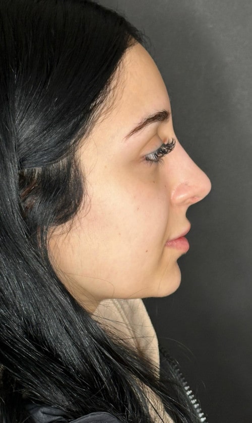 Rhinoplasty – four months post-op side profile showing natural tip lift and smoother nasal contour