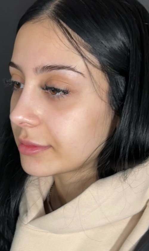 Rhinoplasty – after surgery front view showing smoothed nasal bridge and lifted tip