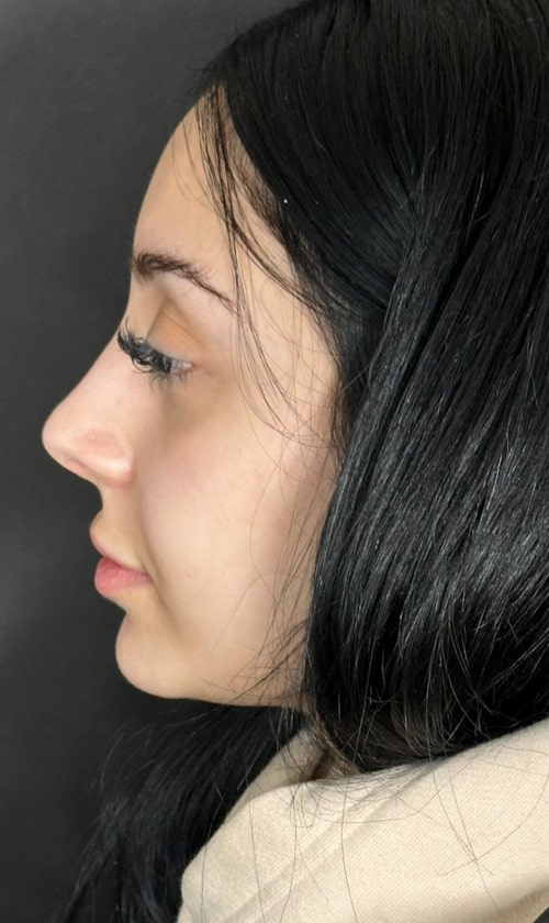 Rhinoplasty – after surgery side profile showing improved tip and balanced nasal contour