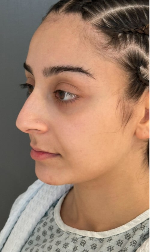 Rhinoplasty – before surgery showing patient’s nose from the front with dorsal bump and droopy tip
