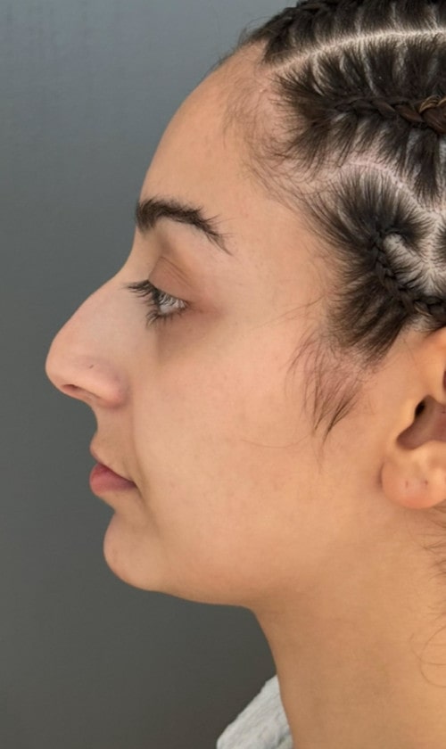Rhinoplasty – before surgery showing side profile with dorsal bump and droopy tip
