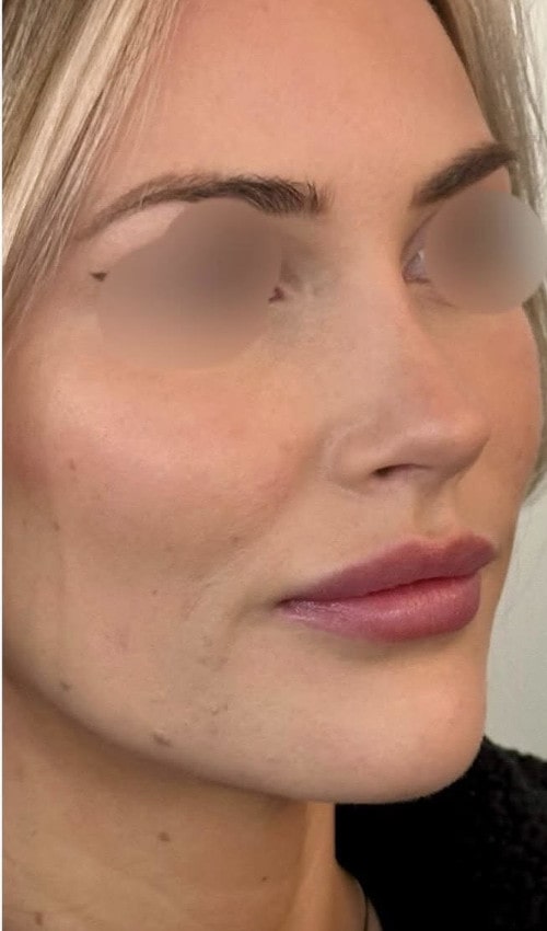 Rhinoplasty – three months post-op front view showing balanced nose with lifted and refined tip