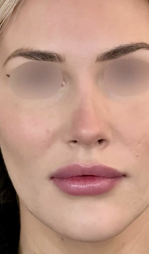 Rhinoplasty – six months after surgery front view showing refined tip and reduced bridge