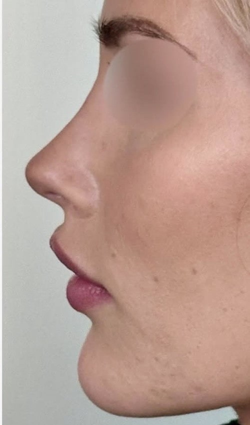 Rhinoplasty – six months after surgery side profile showing lifted and refined tip with smooth bridge