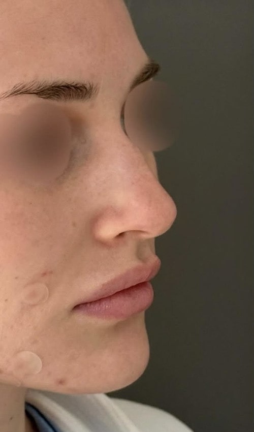 Rhinoplasty – three months after surgery front view showing early results of refined tip and soft bridge curve