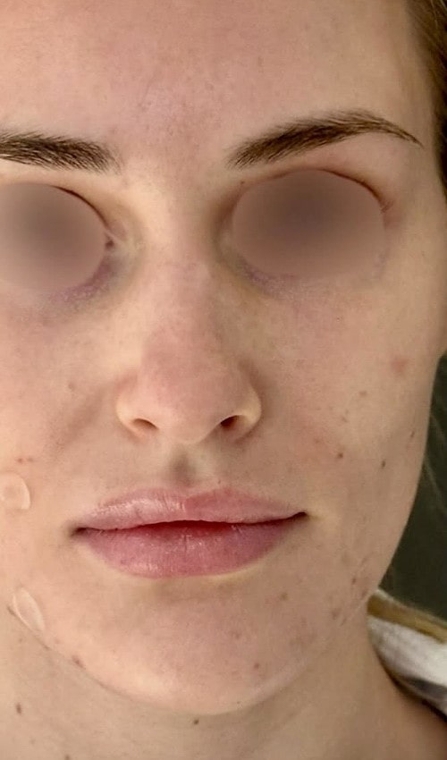 Rhinoplasty – before surgery showing patient’s nose from the front with prominent bridge and droopy tip