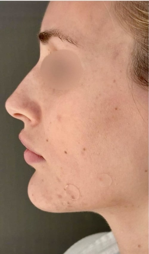 Rhinoplasty – before surgery showing side profile with dorsal hump and tip projection