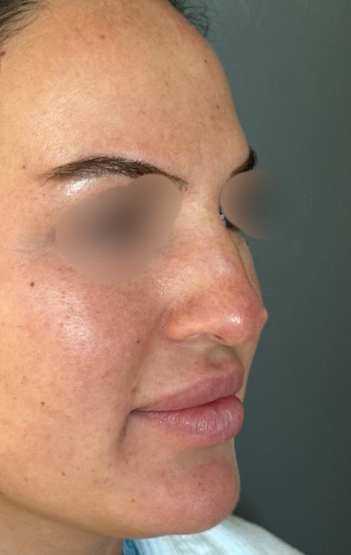 Rhinoplasty – 4 months after surgery showing naturally lifted tip from the front