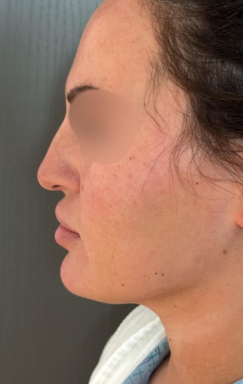 Rhinoplasty – 4 months after surgery showing improved side profile and lifted tip