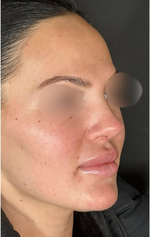 Rhinoplasty – four months post-op front view showing natural tip lift and refined nasal shape