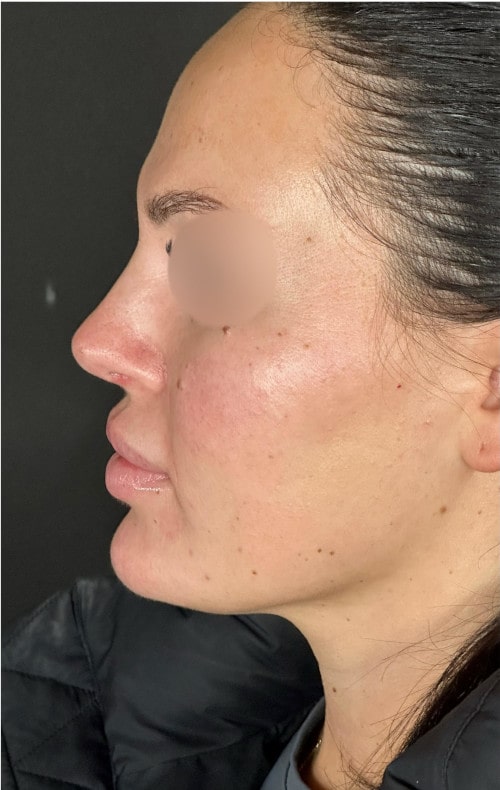 Rhinoplasty – four months post-op side profile showing harmonious tip and nasal contour