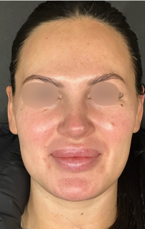 Rhinoplasty – after surgery front view showing lifted nasal tip and balanced nose