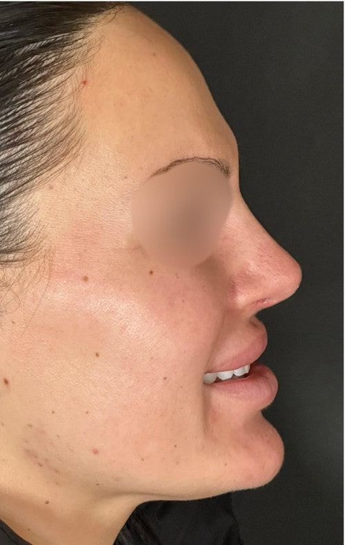 Rhinoplasty – after surgery side profile showing improved tip position and smoother contour
