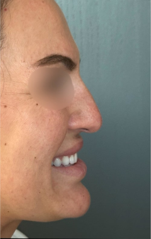 Rhinoplasty – before surgery showing side profile with droopy tip