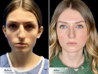 Primary Rhinoplasty Before and After