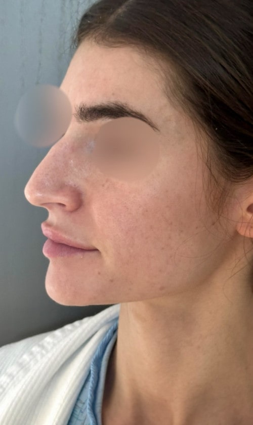 Rhinoplasty – 1 year after surgery showing refined and balanced nose from the front