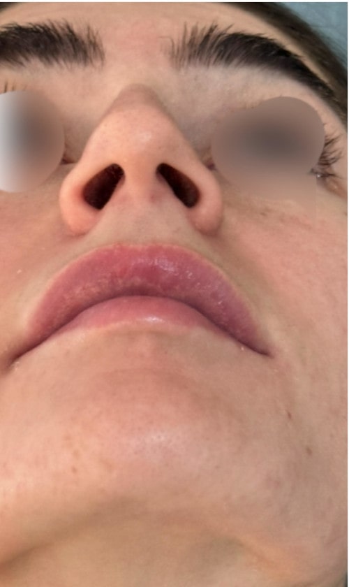 Rhinoplasty – 1 year after surgery showing elegant nasal shape and balanced profile