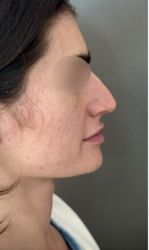 Rhinoplasty – 1 year after surgery showing lifted and refined tip from the side