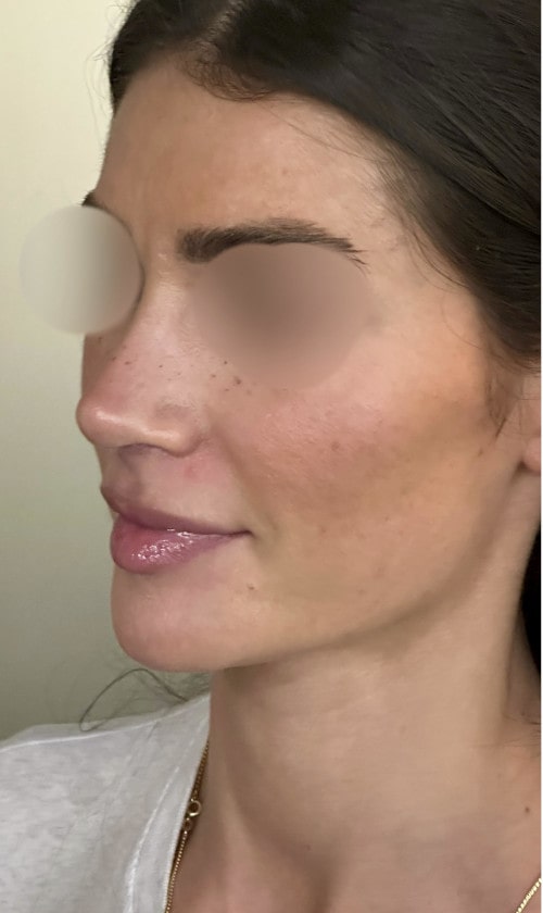 Rhinoplasty – one year post-op front view showing stable, refined nose and natural symmetry