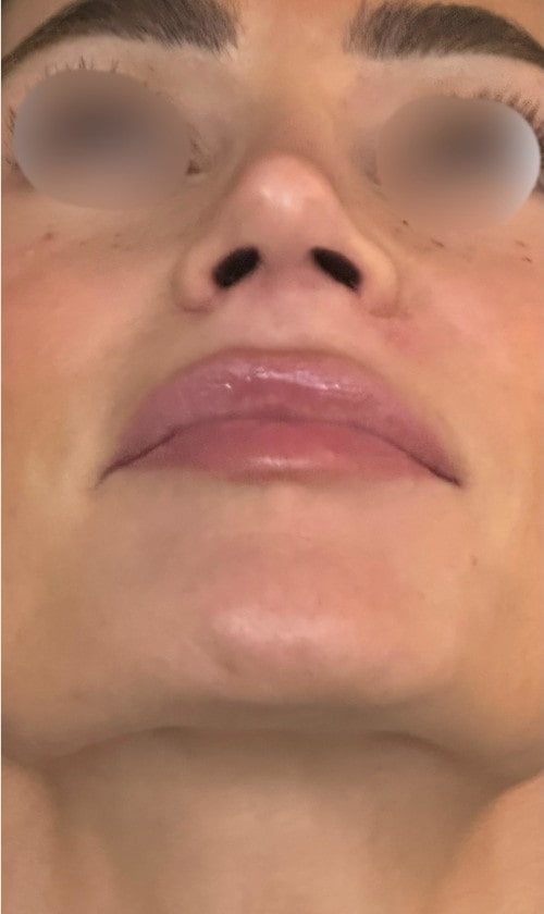 Rhinoplasty – one year post-op profile view showing elegant and balanced nasal shape