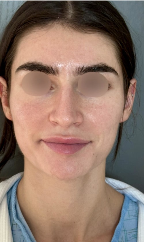 Rhinoplasty – before surgery showing patient’s nose from the front view