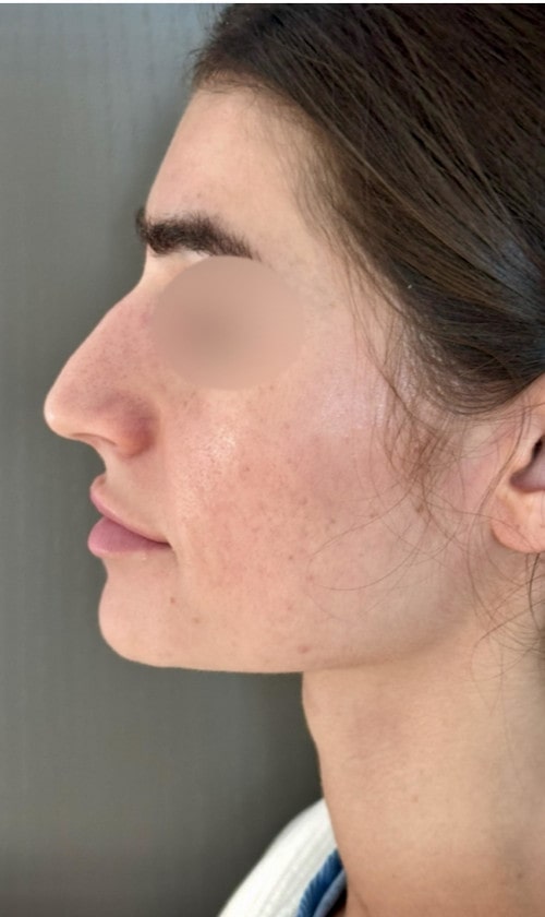 Rhinoplasty – before surgery showing side profile of patient’s nose