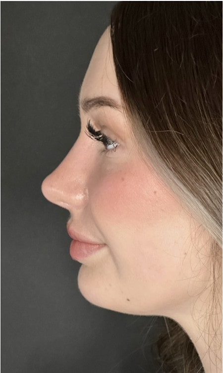 Rhinoplasty – one year post-op side profile showing lifted tip and balanced nasal contour