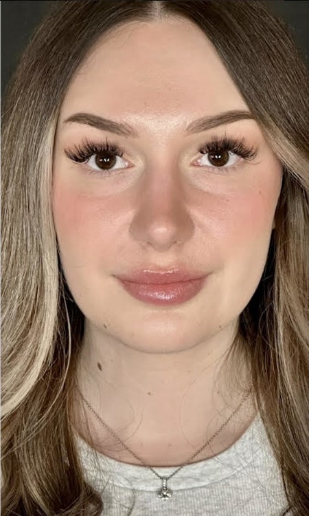 Rhinoplasty – after surgery front view showing shorter and refined nasal shape