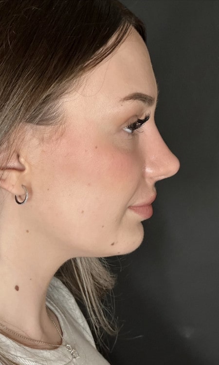 Rhinoplasty – after surgery side profile showing smoother bridge and lifted tip