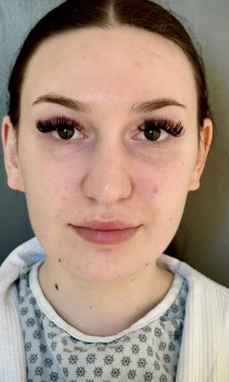 Rhinoplasty – before surgery showing patient’s nose from the front with dorsal bump