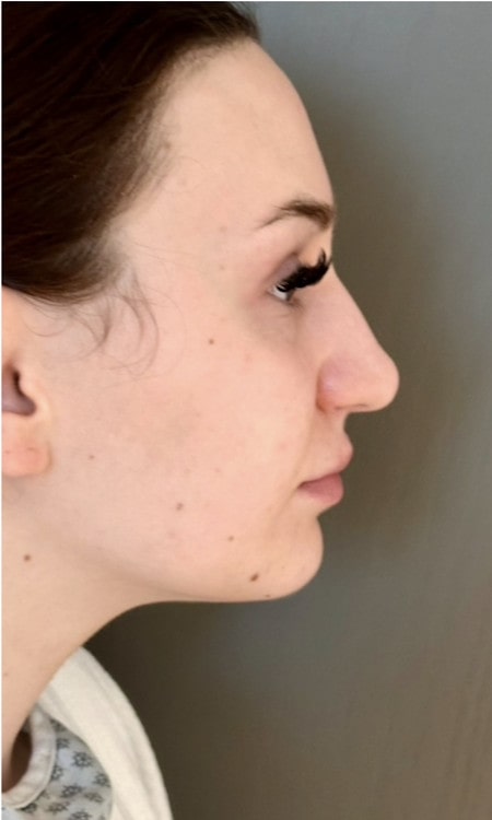 Rhinoplasty – before surgery showing side profile of the nose