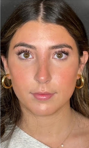 Septorhinoplasty – one year post-op showing stable results and harmonious nasal proportions