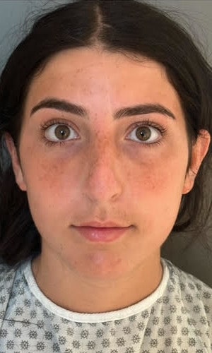 Septorhinoplasty – improved profile and refined tip