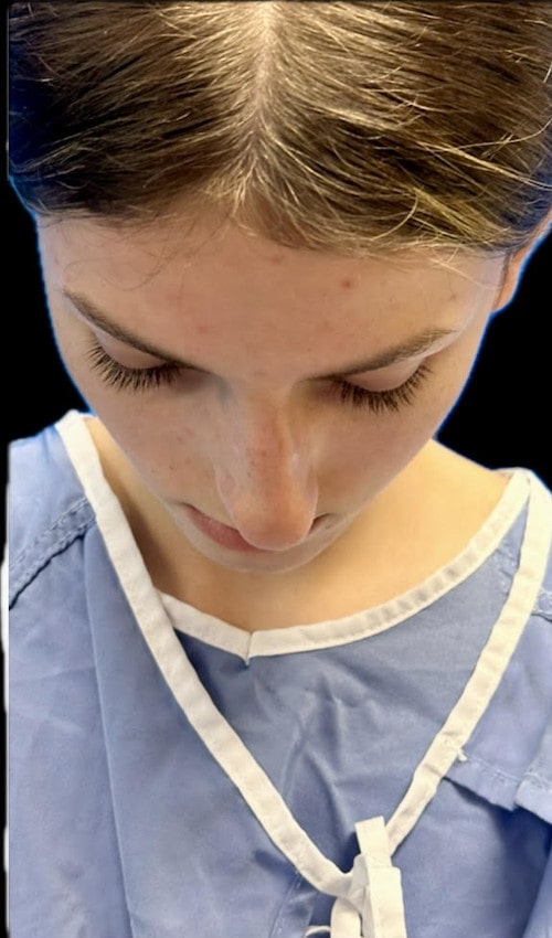 Septorhinoplasty – 1 year after surgery showing straighter, balanced nose from the front
