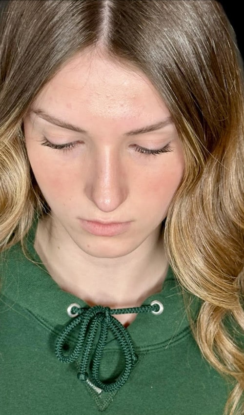 Septorhinoplasty – one year post-op front view showing stable, straightened, and natural nose