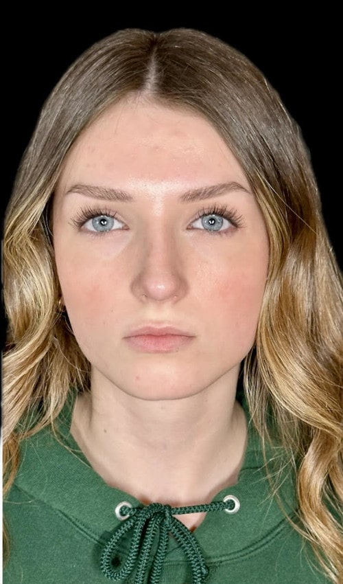 Septorhinoplasty – after surgery front view showing straightened and balanced nasal shape