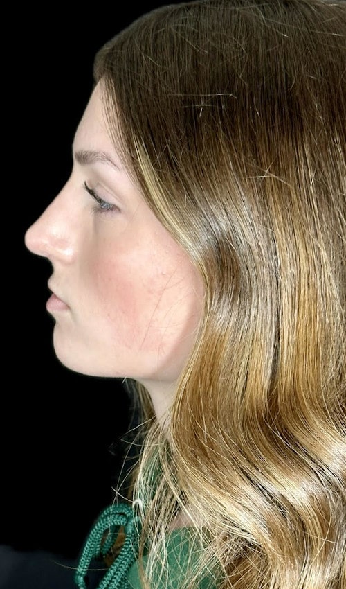 Septorhinoplasty – after surgery side profile showing improved nasal bridge and refined tip