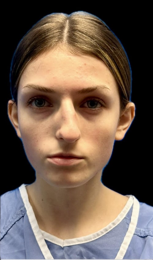 Septorhinoplasty – before surgery showing severely deviated nose from the front