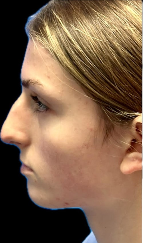 Septorhinoplasty – before surgery showing side profile of deviated nasal bridge