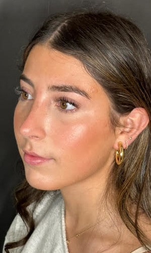 Septorhinoplasty – after surgery front view showing straightened nose and improved symmetry